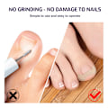 Pikkukuva 7 / 8: 50 kpl sisäänkasvaneiden varpaiden kynsien korjaustarra Nail Strip Corrector St