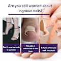 Pikkukuva 2 / 8: 50 kpl sisäänkasvaneiden varpaiden kynsien korjaustarra Nail Strip Corrector St