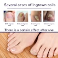 Pikkukuva 6 / 8: 50 kpl sisäänkasvaneiden varpaiden kynsien korjaustarra Nail Strip Corrector St