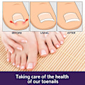 Pikkukuva 4 / 8: 50 kpl sisäänkasvaneiden varpaiden kynsien korjaustarra Nail Strip Corrector St