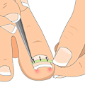 Miniatyrbillede 3 af 5: Indgroede tånegl pedicure værktøj 10stk/ lige klip buet Bs bøjle tånegle tyk paronychia