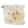 Ny Dental Undervisning Studie Standard Tandmodell Demonstration Sjukdom Utbildning