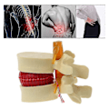 Miniatyrbillede 2 af 5: Lumbal Spinal Disk Brok Rygsøjle Anatomisk Anatoyellow1stk Banmo