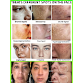 Miniatyrbilde 3 av 8: Mørke flekker fjerner for ansikt sol melasma fregner pigment alder flekker fjerning