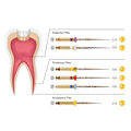 Miniatyrbilde 4 av 9: 5 Esker Dental Endodontic Gull Stor Taper File Rotary Files Engine