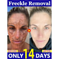 Miniatyrbilde 2 av 5: Mørk flekk fjerner for ansikt fjern melasma fjerning depigmentering
