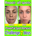 Pikkukuva 5 / 8: Tumman täplän poistoaine kasvoille aurinko melasma pisamia pigmentti ikä täplät poisto