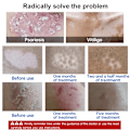 Miniatyrbillede 2 af 7: UVB Fototerapi Lampe Enhed til Vitiligo Behandling UV Smalt bånd Ultraviolet Lys terapi