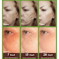 Miniatyrbillede 4 af 5: Fregner fjernelse essens fjern ansigtsbehandling pletter hud mørk plet fjern melasma pletter solpletter hvidning og fregne fjernelse creme