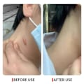 Miniatyrbillede 4 af 6: Ar fjernelse creme effektiv behandling stræk mærker forbrænding fade acne pletter sektion ar gel
