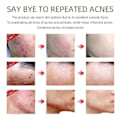 Miniatyrbild 4 av 5: Acne Behandling Serum Återfuktande Närande Torrt Ansiktsvård Firming Shrink Porer Oil Control Multi-effect Skin Essence