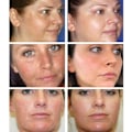 Miniatyrbillede 7 af 7: Ansigtsbehandling pletter hud mørk plet fjern melasma alder pletter solpletter hvidning og fregne fjernelse creme