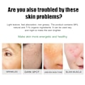 Miniatyrbillede 2 af 9: Blegning ansigt creme fjernelse rynker fregne fjernelse anti-acne behandling fade fine linjer
