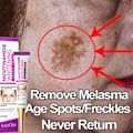 Miniatyrbilde 2 av 7: Ansikts flekker hud mørk flekk fjern melasma alder flekker solflekker bleking og fregne fjerning krem