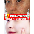 Pikkukuva 4 / 8: Tumman täplän poistoaine kasvoille aurinko melasma pisamia pigmentti ikä täplät poisto