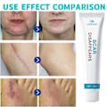 Miniatyrbillede 7 af 7: Recovery Ar Cream Hurtig Fjernelse Stræk Mærker Forbrændinger Keloider Behandling Kirurgi Ar Pigment Urte Reparation Hud Ar Glat Gel