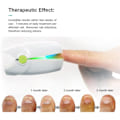 Miniatyrbild 5 av 6: Nagel svamp laser nagelbehandlingar apparat mycket effektiv ljusbehandling för fingernaglar