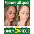 Miniatyrbilde 2 av 8: Mørke flekker fjerner for ansikt sol melasma fregner pigment alder flekker fjerning