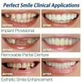 Miniatyrbild 4 av 5: Smile Knäpp på löständer Nedre och övre tandfasader Set Cover null none