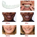 Miniatyrbilde 2 av 5: Snap On Teeth Veneers, perfekte midlertidige erstatninger for tenner