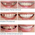 Miniatyrbillede 2 af 5: Bøjler til proteser, Magic Teeth midlertidige kosmetiske tænder, midlertidige smil behagelig pasform elastiske kosmetiske tænder, øverste og nederste midlertidige dent