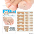 Miniatyrbild 1 av 3: Nail Correction Patch Ingredient Toenail Correction Patch Paronychia Treatment