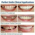 Miniatyrbillede 4 af 5: Smile seler Snap på øvre og nedre falske tænder Dental Finer Protese Cover Set 2 Set