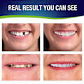 Miniatyrbild 4 av 4: 2 Sets Of Dentures, Upper And Lower Jaw Dentures, Natural And Comfortable, Protect The Teeth, And Regain A