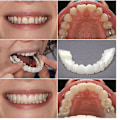 Miniatyrbillede 3 af 3: Snap On falske tænder, øvre + nedre tandfacader, proteser, tandsæt A Upper Lower teeth