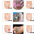 Miniatyrbild 4 av 5: Tånagelskorrigerare för Professionell Nagelbehandling, Inåtväxt Tånagellyftare Smärtfri Nagelkorrigering för Mångsidigt Nagelverktyg, Högkvalitativ Zinkaluminium