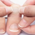 Miniatyrbillede 2 af 5: Indgroet tånegl korrektion tå neglebehandling Elastisk plaster 20Pcs