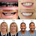 Miniatyrbilde 2 av 5: Midlertidige Proteser Rask Tannprotese Topp Perfekt Smil Fasader, Reparer Tannen Raskt, Få Deg Til Å Smile Selvsikkert