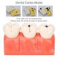 Miniatyrbild 6 av 8: Högt Simulerad Dental Undervisningshjälp, Syntetisk Hartstandmodell För Professionell Träning Och Utbildning, Tydlig Morfologisk Struktur, Vuxen