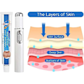 Miniatyrbillede 3 af 5: VeinsHealth Åreknuder Blåt Lys Terapi Sæt, Åreknuder Behandling Blåt Lys Laser Behandling Pen, Åreknuder Creme 1pen x 1cream