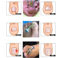 Miniatyrbild 4 av 4: Professionellt verktyg för korrigering av nageltrång, nagelklipp för nageltrång, regenererar nageltrång, pedikyr