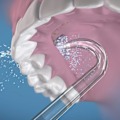 Pikkukuva 3 / 5: 2 Vaihtokärkeä Implanttihammasproteeseihin [HK]