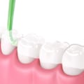 Miniatyrbilde 4 av 10: 20 stk. Fjerningsverktøy Invisalign Klare alignere for tenner