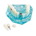 Miniatyrbillede 5 af 10: Anatomisk Tandmodell - Tandprotes Blue