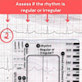 Miniatyrbild 3 av 5: 2 st ECG 7-stegs linjal ECG 7-stegs linjal för EKG EKG-tolkning ECG-linjal Bärbar ECG-bedömning