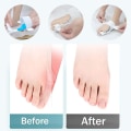Miniatyrbillede 5 af 5: Hallux Valgus Separator Corrector Rails til lindring af smerter til mænd og kvinder i universel størrelse