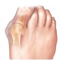 Miniatyrbild 4 av 5: Hallux Valgus skydd & tåspridare  (ORTISPHERE-Original)