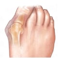 Miniatyrbild 4 av 5: Hallux Valgus skydd & tåspridare  (ORTISPHERE-Original)