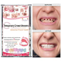 Miniatyrbild 4 av 5: Temporär tandtejp för kronor, porslinsfasader för främre och bakre tänder front teeth