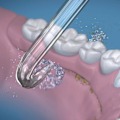 Pikkukuva 2 / 5: 2 Vaihtokärkeä Implanttihammasproteeseihin