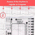Miniatyrbillede 3 af 5: 2 stk. EKG 7-trins lineal, EKG 7-trins lineal til EKG/EKG-fortolkning, EKG-lineal, bærbar EKG-vurdering