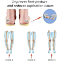 Miniatyrbild 3 av 5: Supinationssulor för översupination & högt fotvalv, ortopediska inlägg för fotinriktning, knackeknä, kobenta, O/X-benthet Size  39-40