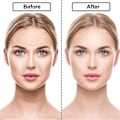 Miniatyrbillede 5 af 5: IC Face Patch Anti Aging - Beskyttelse mod rynker i panden, øjenrynker