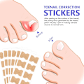 Miniatyrbild 3 av 5: Behandling av nageltrång, 100 st andningsbara korrigeringsplåster, smärtfri nagelkorrigering, nageltrångremsor, behandling av nageltrång