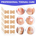 Miniatyrbild 2 av 5: Behandling av nageltrång, 100 st andningsbara korrigeringsplåster, smärtfri nagelkorrigering, nageltrångremsor, behandling av nageltrång