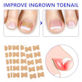Miniatyrbild 5 av 5: Behandling av nageltrång, 100 st andningsbara korrigeringsplåster, smärtfri nagelkorrigering, nageltrångremsor, behandling av nageltrång